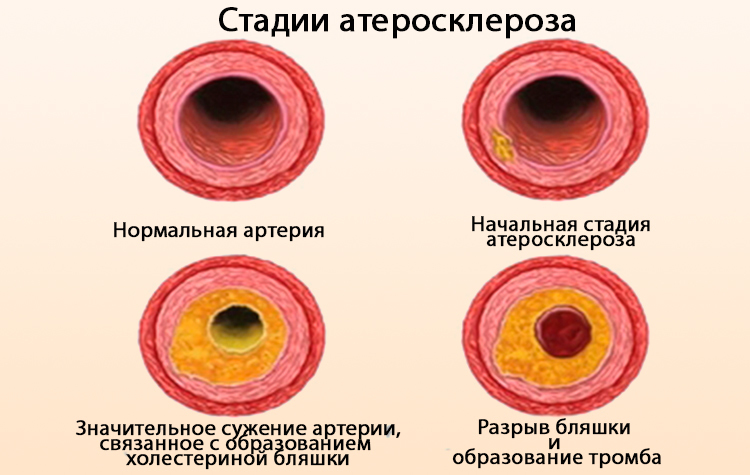 Предотвращение глаукомы и катаракты: Как восстановить зрение БЕЗ операций