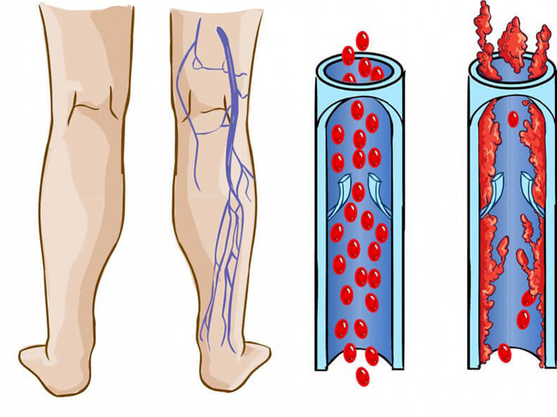 Варикозное расширение вен и тромбофлебит: Как восстановить кровообращение