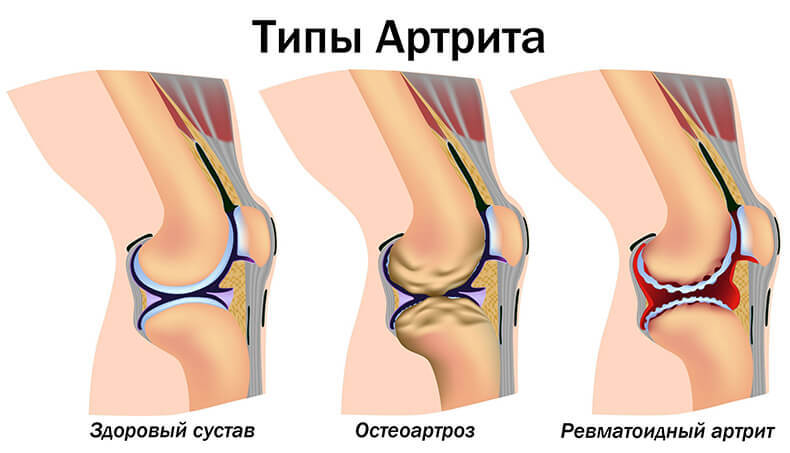 Высокая температура при ревматоидном артрите: что важно знать