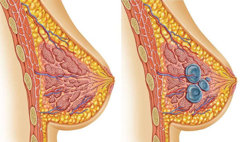 Мастопатия: Что важно знать ВСЕМ женщинам