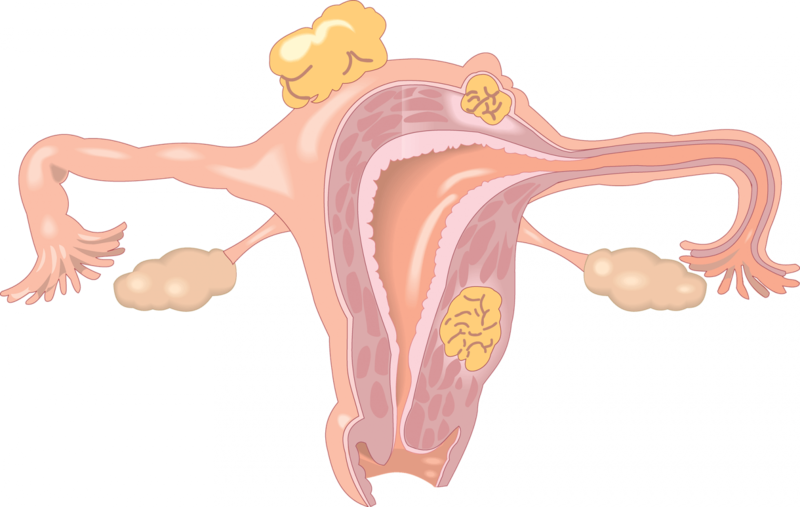 Миома — от обиды, киста — от ревности