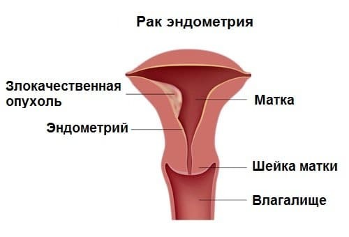 Рак эндометрия: 5 вещей, которые нужно знать!