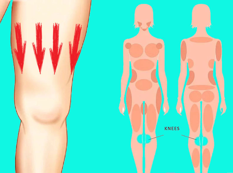 Что делать, если колени — ваша проблемная зона: Советы профессионалов
