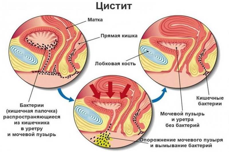 Циститы: Что необходимо знать каждой женщине