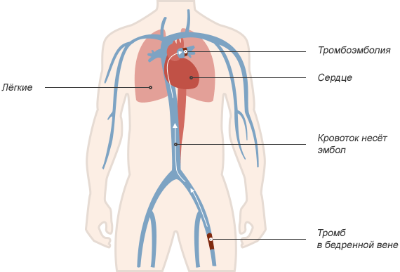 Легочная эмболия: Опасность, которую можно предотвратить