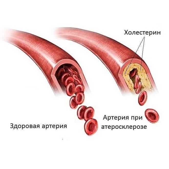 Закупорка сосудов: Основные причины и симптомы 