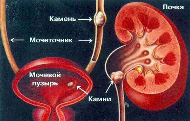 Откуда берутся камни в почках