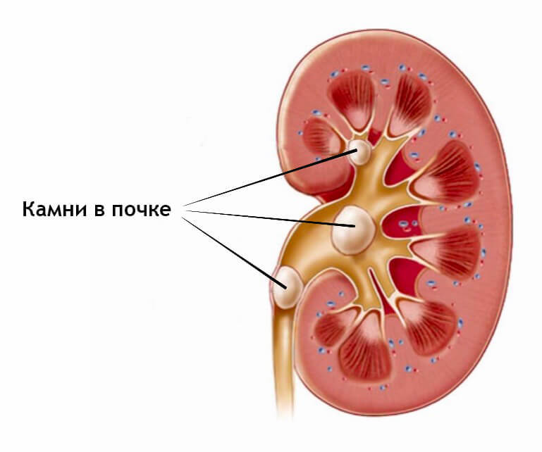 Откуда берутся камни в почках