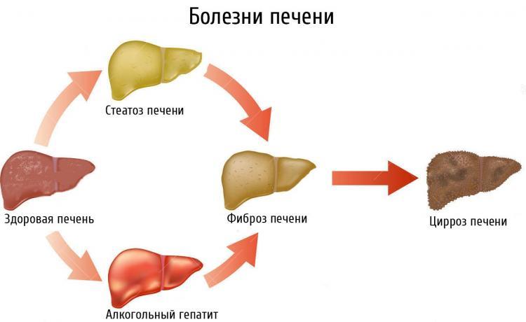 Боли в области печени: 10 возможных причин 