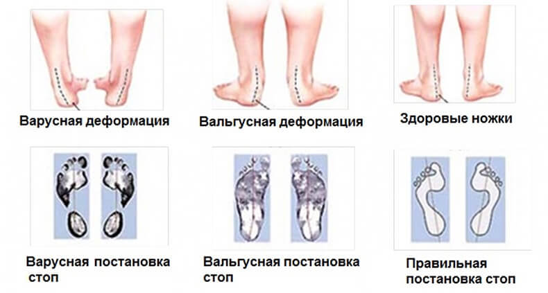 Косолапость: Как лечить варусную деформацию стоп — советы остеопата