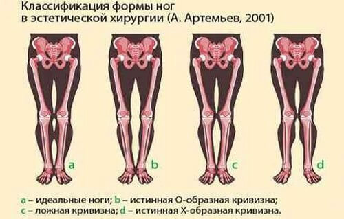 Как исправить кривизну ног: упражнения, которые помогут