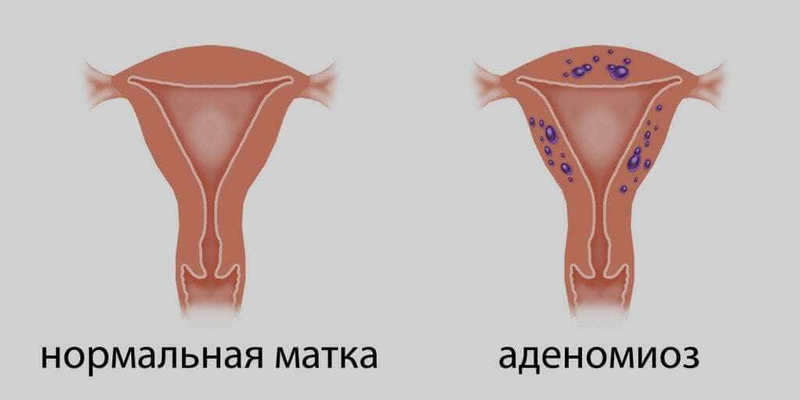 Аденомиоз матки: Что нужно знать женщинам