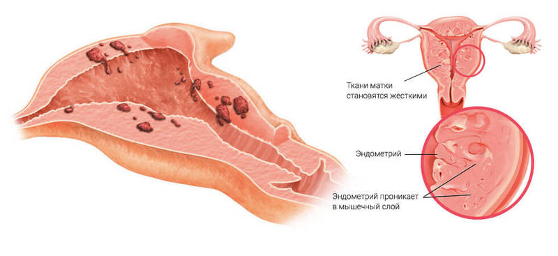 Аденомиоз матки: Что нужно знать женщинам