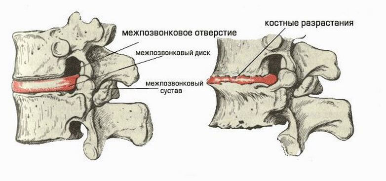 Остеохондроз: Самый ПРОСТОЙ метод лечения