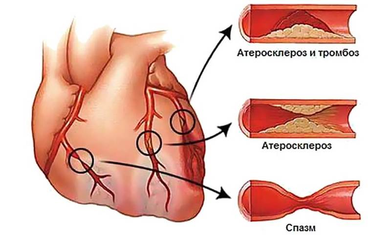 Заболевания сердечно-сосудистой системы: Можно ли вылечить СЕРДЦЕ?