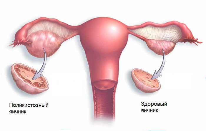 Поликистозный синдром яичников: 5 симптомов, которые нужно знать!