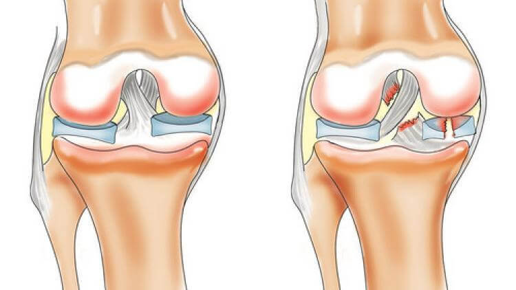 Укрепляющие упражнения для коленного мениска