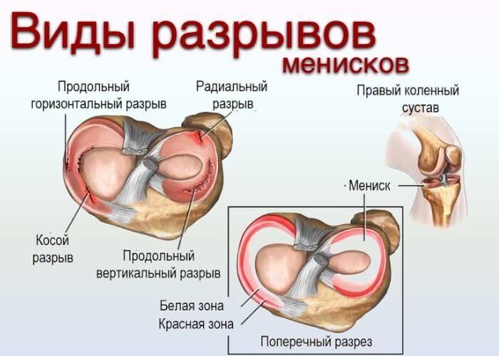 Укрепляющие упражнения для коленного мениска