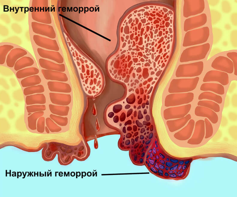 Упражнения восточной медицины от геморроя: Вылечи себя сам!