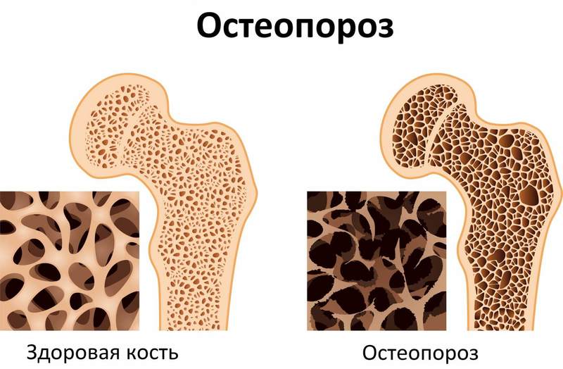 Болезни костей: Связь с почками