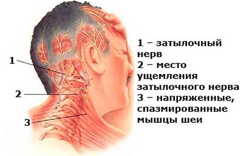 Цервикогенная головная боль: причины и симптомы