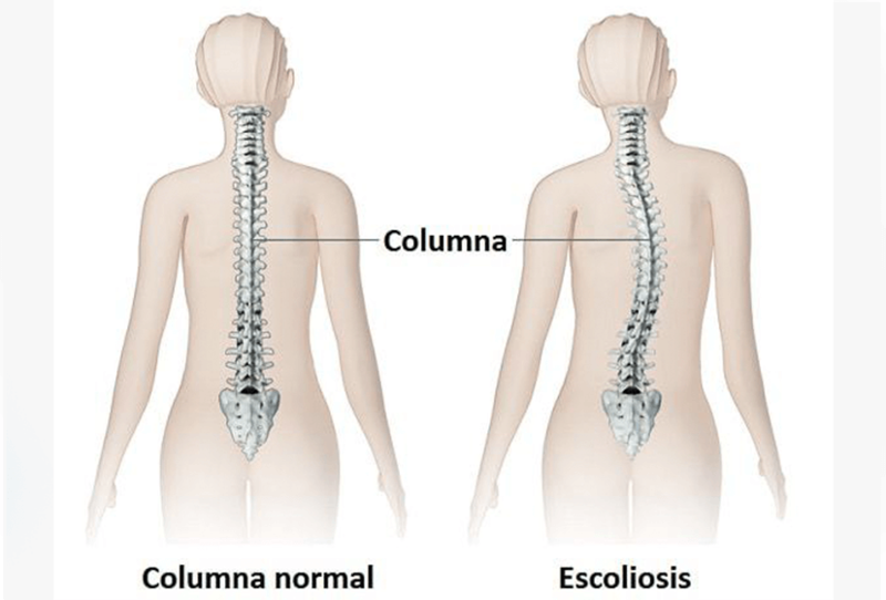 СКОЛИОЗ: Простые упражнения для коррекции 