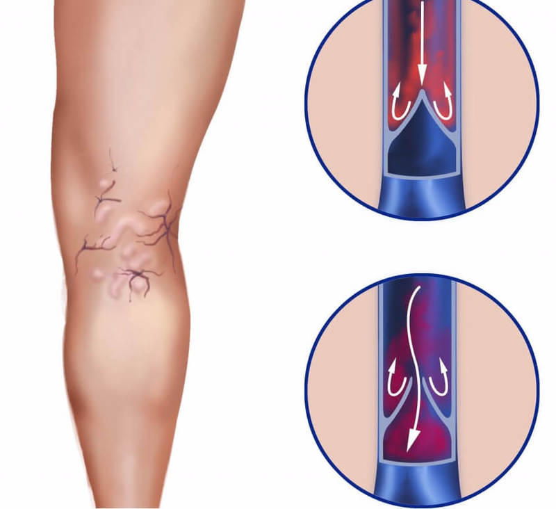 Предотвратить ВАРИКОЗ вен: Что делать и как питаться