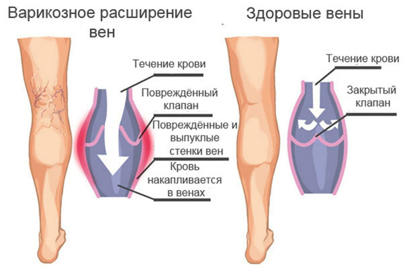 Борьба с варикозом: Полезные и вредные упражнения 