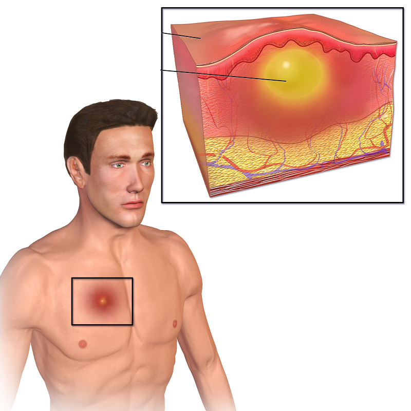 Фурункулы: Болезненные, неудобные и даже опасные!