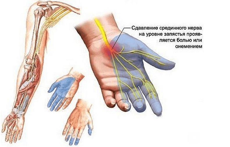 Эти 5 упражнений помогут при синдроме запястного канала