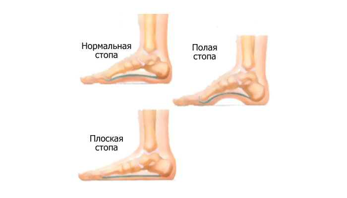 Ласты в ботинках. Всё о стопе