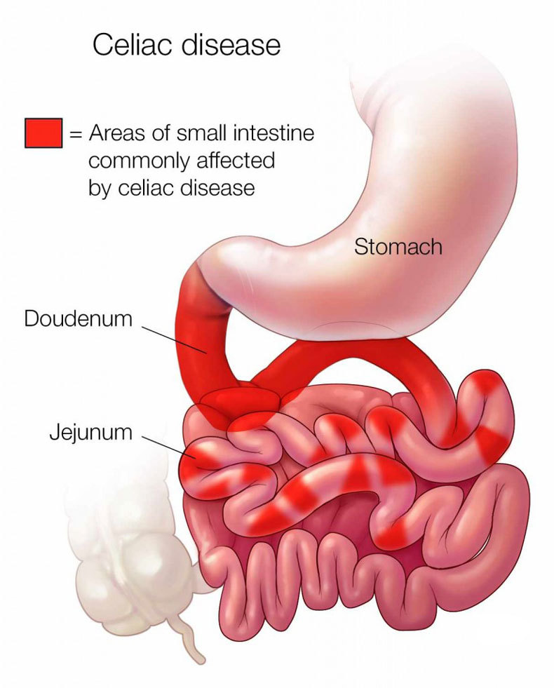 Что такое ЦЕЛИАКИЯ