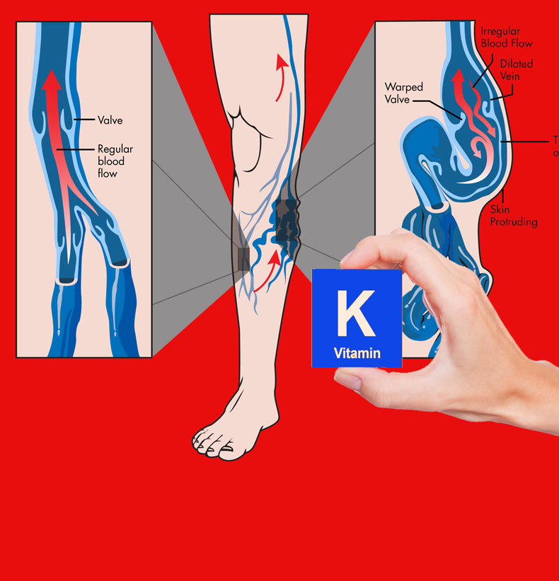 Витамин K для уменьшения варикоза