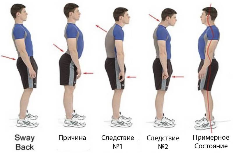 Остеохондроз и его деловые партнеры