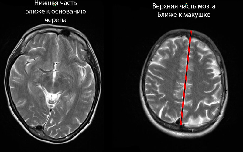 Как остеохондроз может влиять на мозг