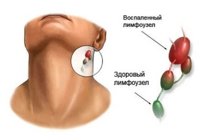 Лимфатическая система: Когда следует беспокоиться?