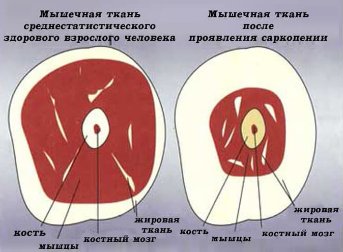 Узнайте, не грозит ли вам САРКОПЕНИЯ?