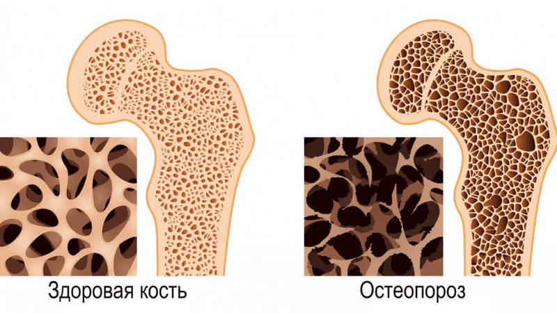 Почему коллаген важнее для костей, чем кальций