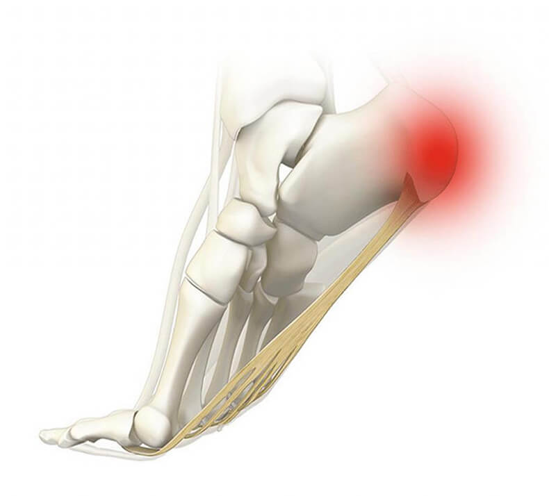 Боль в пятке: 9 возможных причин