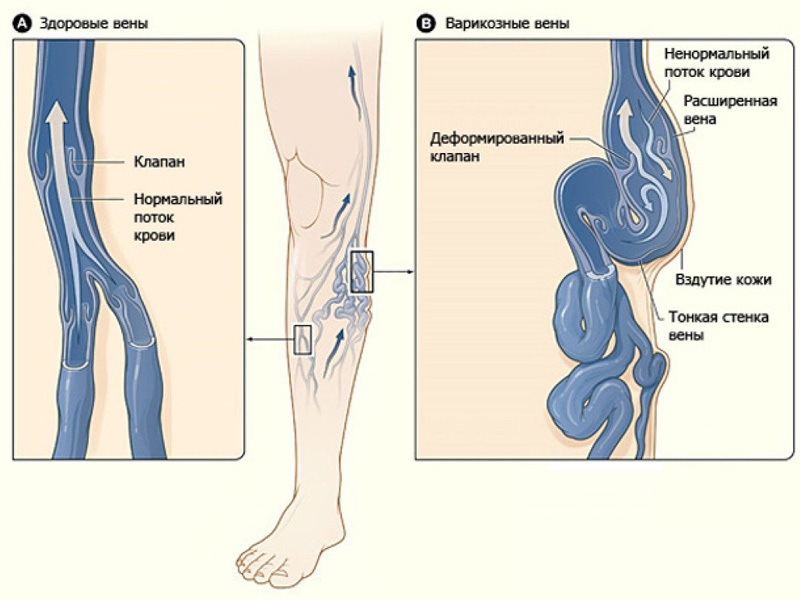 ВАРИКОЗ: Что делать          