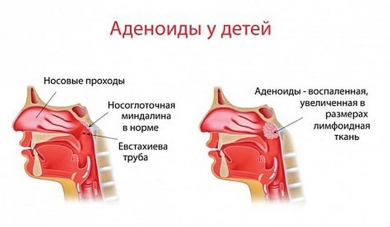 Как избавиться от аденоидов: 2 простых совета 