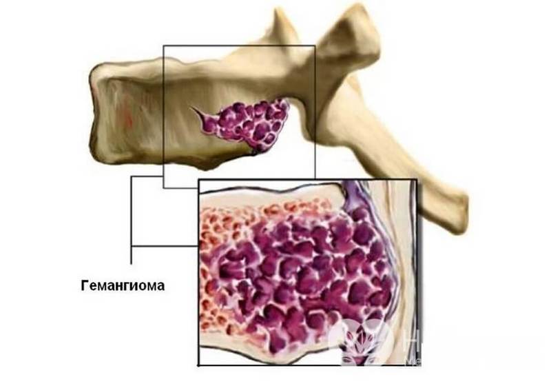 ГЕМАНГИОМА ПОЗВОНОЧНИКА: Стоит ли бояться?