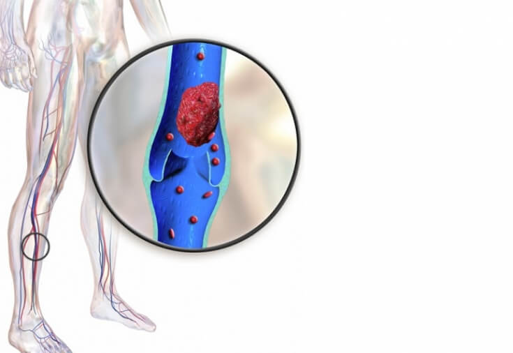Тромбофлебит: 7 рецептов от врача-натуропата