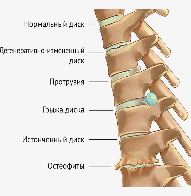 Запрещенные упражнения при грыже межпозвонкового диска