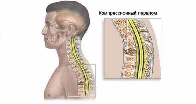 Травмы шейного отдела позвоночника: Как оказать первую помощь