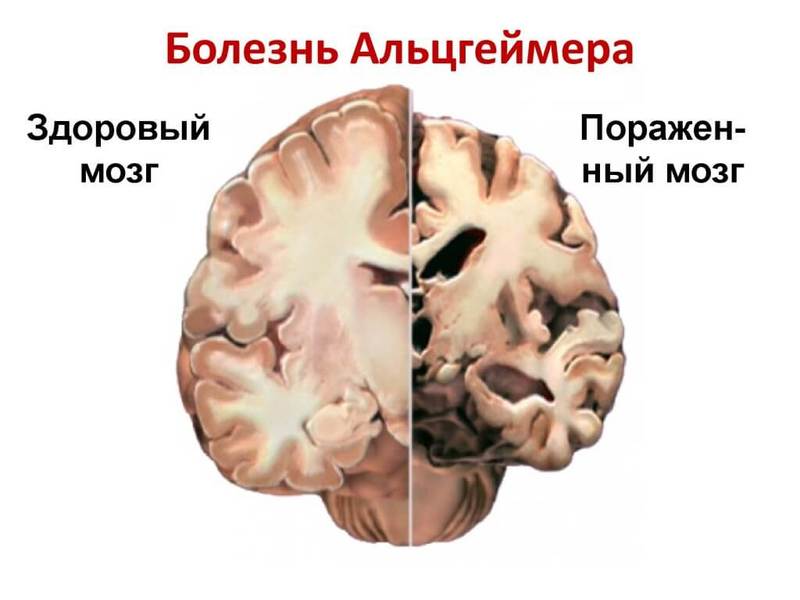 Болезнь Альцгеймера можно определить по глазам