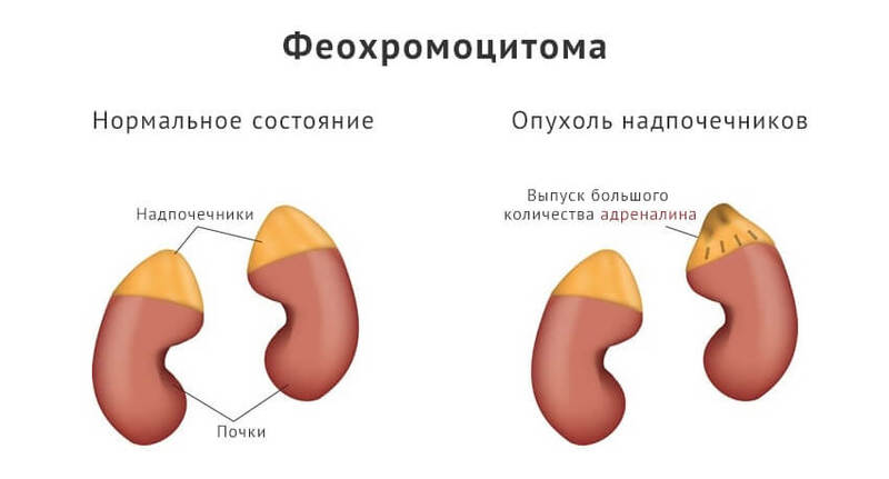 Эндокринные гипертензии: Гормоны могут быть причиной повышенного давления 