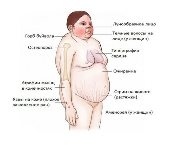 Эндокринные гипертензии: Гормоны могут быть причиной повышенного давления 