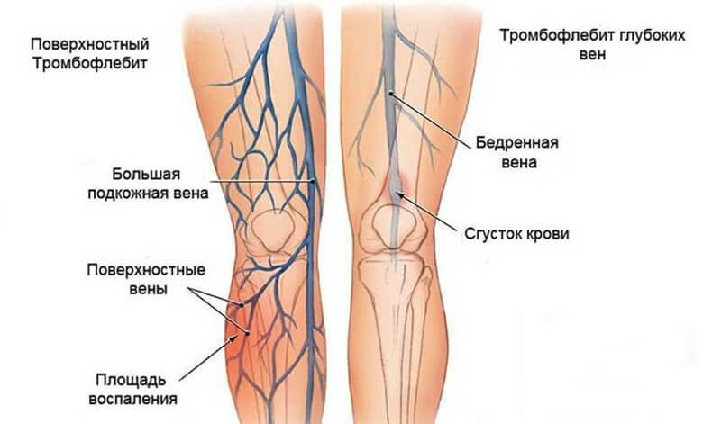 Венозная недостаточность: Полезные советы, позволяющие снизить риск