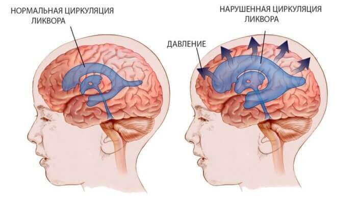 Что это такое ликвор? Лечение спинномозговой жидкости